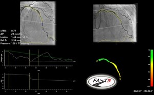 Pie Medical Imaging annuncia di aver completato l'arruolamento dei pazienti nello studio clinico FASTIII